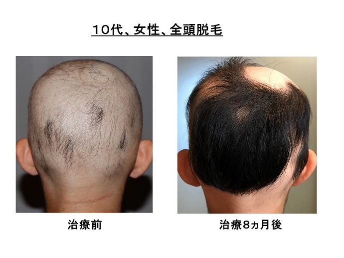 円形脱毛症　病院